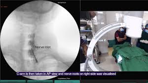 Image result for Lower Cervical Intramuscular Injection