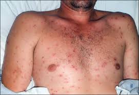 Image result for Generalized Rash