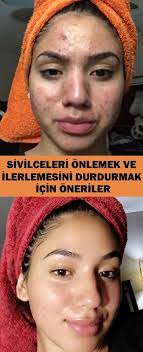 Sivilce Nedir Sivilceler Icin Cok Etkili Dogal Yontemler Vipbakim Sivilce Izi Akne Tedavisi Cilt Urunleri