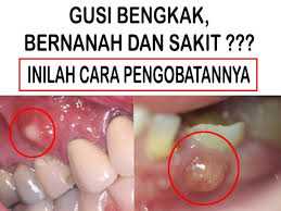 Teh celup atau kantong teh. Gusi Bengkak Isi Nanah