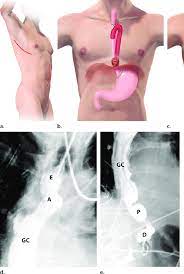 However, in the late postoperative period, disease recurrence becomes an increasing concern. Ivor Lewis Esophagectomy A C Drawings Show Skin Incisions Red Download Scientific Diagram
