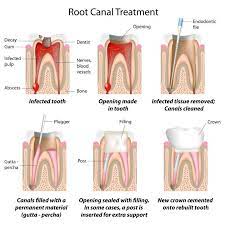 Root Canals The Devastating Truth Revealed Health Root Canal Treatment Dental Treatment Root Canal