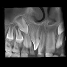 Icd-10 Codes To Report Supernumerary Teeth
