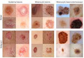 Many patients are caught by surprise when the lesion they had, which turned out to be melanoma or another skin cancer, looked nothing like what they had expected.7. Deep Learning Algorithm Diagnoses Skin Cancer As Well As Seasoned Dermatologists Extremetech