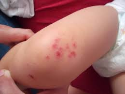 Cliquez ici pour des remèdes contre les piqûres de moustiques. Comment Reconnaitre A Coup Sur Les Piqures De Punaises De Lit
