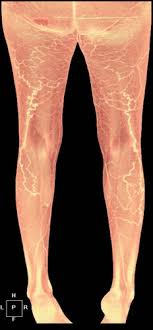 It contains many muscles and nerves but only has one bone, the femur, which is the longest and strongest bone in the human body. Unusual Causes Of Varicose Veins In The Lower Extremities Ct Venographic And Doppler Us Findings Radiographics