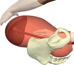 Image result for Retained Placenta