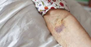 Ringworm is a fungal infection that can look like white, pink, red, or brown patches. What Is Senile Purpura Causes Symptoms Diagnosis And Treatment Tips