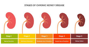 Maybe you would like to learn more about one of these? Understanding Chronic Kidney Disease Miskawaan Health