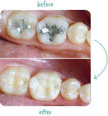 Do teeth fillings hurt metal. Dental Fillings Education Center Lane And Associates Family Dentistry