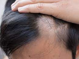 These follicles are still present. Women Lost Hair After Getting Food Poisoning From Pumpkin And Squash