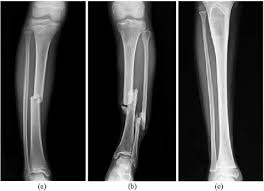 The bones of the hip include the femur, the ilium, the ischium, and the pubis. Scanning X Ray Image Of Lower Leg Bone Download Scientific Diagram