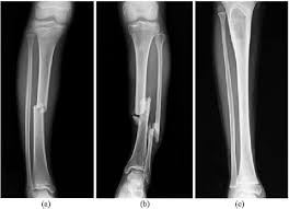 The humerus and the femur are corresponding bones of the arms and legs, respectively. Scanning X Ray Image Of Lower Leg Bone Download Scientific Diagram