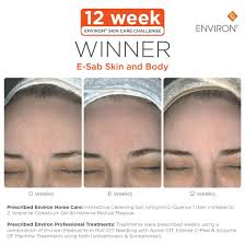 Environ skin care south africa. This Is What Natural Regeneration From Needling Looks Like A Thicker More Refined Texture With Reduction Of Sun Dam Skin Care Challenge Skin Clinic Treatment