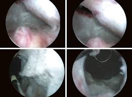 Urinary Retention An Overview Sciencedirect Topics