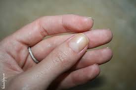 Micozele sunt extrem de contagioase: Unghiile Galbene InseamnÄƒ MicozÄƒ Sau Prezic Una Din Aceste 11 Boli Ea Md