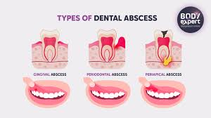 Image result for granuloma gum disease