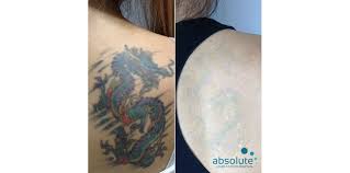 Find updated content daily for laser tattoo removal. Tattoo Removal White Ink