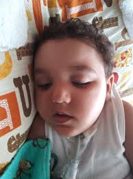 Rett syndrome support group for parents