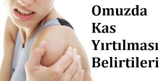 Omuzda Kas Yirtilmasi Belirtileri Tedavisi Ve Ameliyati Saglik Haberleri
