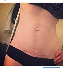 My new channels @fashion with stesha and @fitness with stesha. Cesarean Delivery Scar