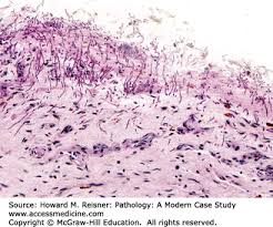 Eosinophilic esophagitis attributed to gastroesophageal re. Pathology Of The Gastrointestinal Tract Basicmedical Key