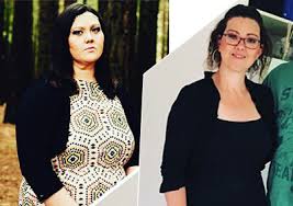 Weight Loss Surgery Success Before After Darebin Weight Loss Surgery