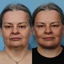 We are so excited to have our very first facial plastic and reconstructive  surgery fellow joining us this year! Dr. Rachel Fee just completed her  residency training with us and will now