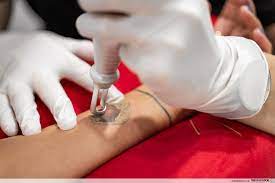 Dr kevin chua medical & aesthetics specializes in safe and effective laser tattoo removal techniques. I Went For Tattoo Removal In Singapore To Undo My Poor Ink Choices 10 Years Ago