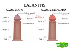 Glande Inflamado Balanitis Y Balanopostitis En Ninos Como Tratarlo Mi Bebe Y Yo