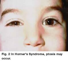 Anisocoria And Horner S Syndrome Eyes 4 Kids