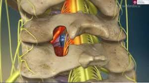 Hernia de disc cervicala cauzeaza compresia nervului cervical, ceea ce inseamna ca apar dureri care iradiaza catre brate. Hernia De Disc Cervicala Dr Dan Martin