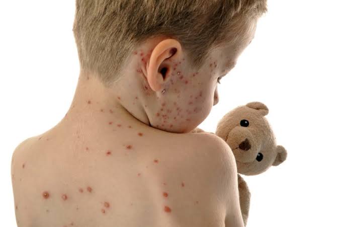 Karachi Measles and Diphtheria Deaths Reach 144 in 2026