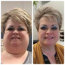 Bariatric surgery weight loss journey in Las Vegas