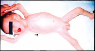 Image result for Allergic Colitis of Infancy