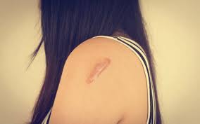 Jun 29, 2021 · après une petite vague en août 2020, le coronavirus n'a pas vraiment refait surface. Cicatrices Peut On Les Faire Disparaitre Definitivement Centre Esthetique Lyon Tete D Or