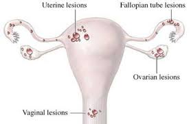 Endometriosis is a reproductive disorder that happens when cells from the uterine lining—or cells really similar to the ones in that lining—wind up on other organs where they don't belong. Endometriosis Symptoms And Treatment Options Appledore Medical Group