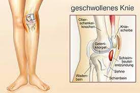 Schleimbeutelentzundung Bursitis Ursachen Symptome Diagnose Behandlung Hausmittel Krank De
