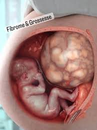 Fibrome traitement naturel