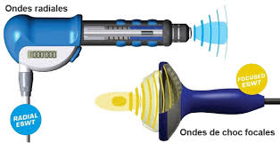 Ce traitement par ondes de choc viendra renforcer l'ensemble des techniques actuellement utilisées dans la prise en charge de ces tendinopathies. Les Ondes De Choc Traitement Recommande Mais Pas Rembourse Onde De Choc