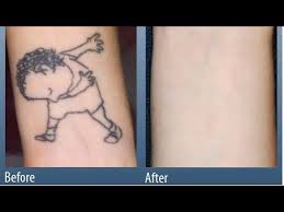 Other options for removing tattoos at home include applying lemon juice, honey or a mixture of aloe vera, paederia tomentosa, and vitamin e. Tattoo Removal Laser Surgery Home Remedy 3n Vlogs By Wing Boy