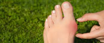 Ayak parmaklar yayılmıştır yıllardır çektiğim için bilirim mesela reebok genelde geniş taraklı ayakkabı üretir nike'ın yanında bile geçmem. Halluks Valgus Nedir