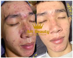 Feedback khách hàng trước và sau điều trị mụn viêm