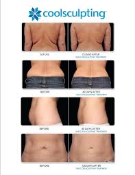 Pin On Body Contouring
