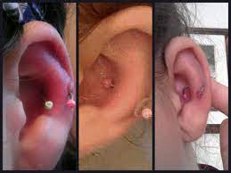 This Result Is The Usual Outcome When Nopull Piercing Disc Is Worn Against A Cartilage Bump Hypertrophic Scar Cool Piercings Piercing Cartilage Piercing Care