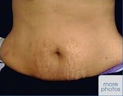 Take Coffee Grinds With Olive Oil And Make Into A Paste Massage Well Into The Area With Stretch Marks For About Health And Beauty Beauty Health Beauty Hacks