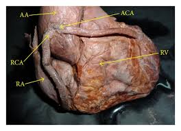 Plaque is made up of cholesterol deposits. An Anomalous Configuration Of Coronary Artery A Cadaveric Study