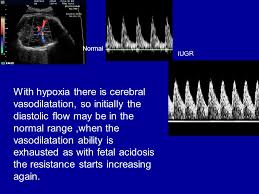 Middle Cerebral Artery Doppler Ppt Video Online Download