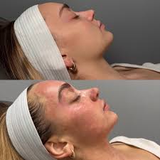 Meet Alyssa, our wellness NP 💉 She specializes in GLP-1 support, Thorne  supplements, and wellness shots — plus SkinPen, RF microneedling, and  Emsculpt. Her goal? Helping you feel energized, confident, and glowing