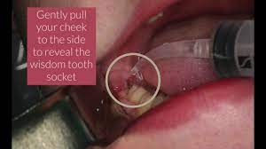 You probably experience a dry socket if you can look into your open mouth in a mirror and see the bone where your tooth was before. Postoperative Care Preoperative Care Innovative Implant Oral Surgery